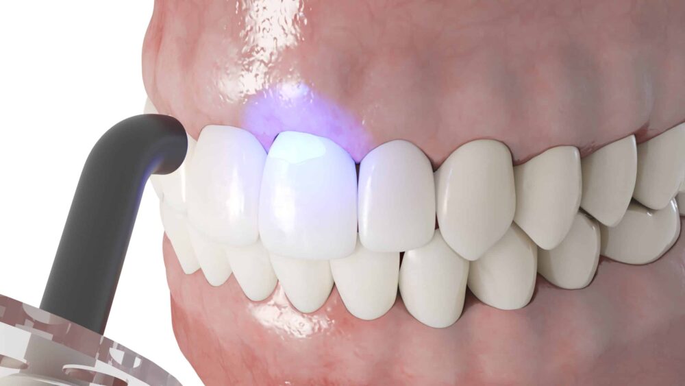 Dental Bonding in Rockwall